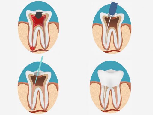 Endodoncia