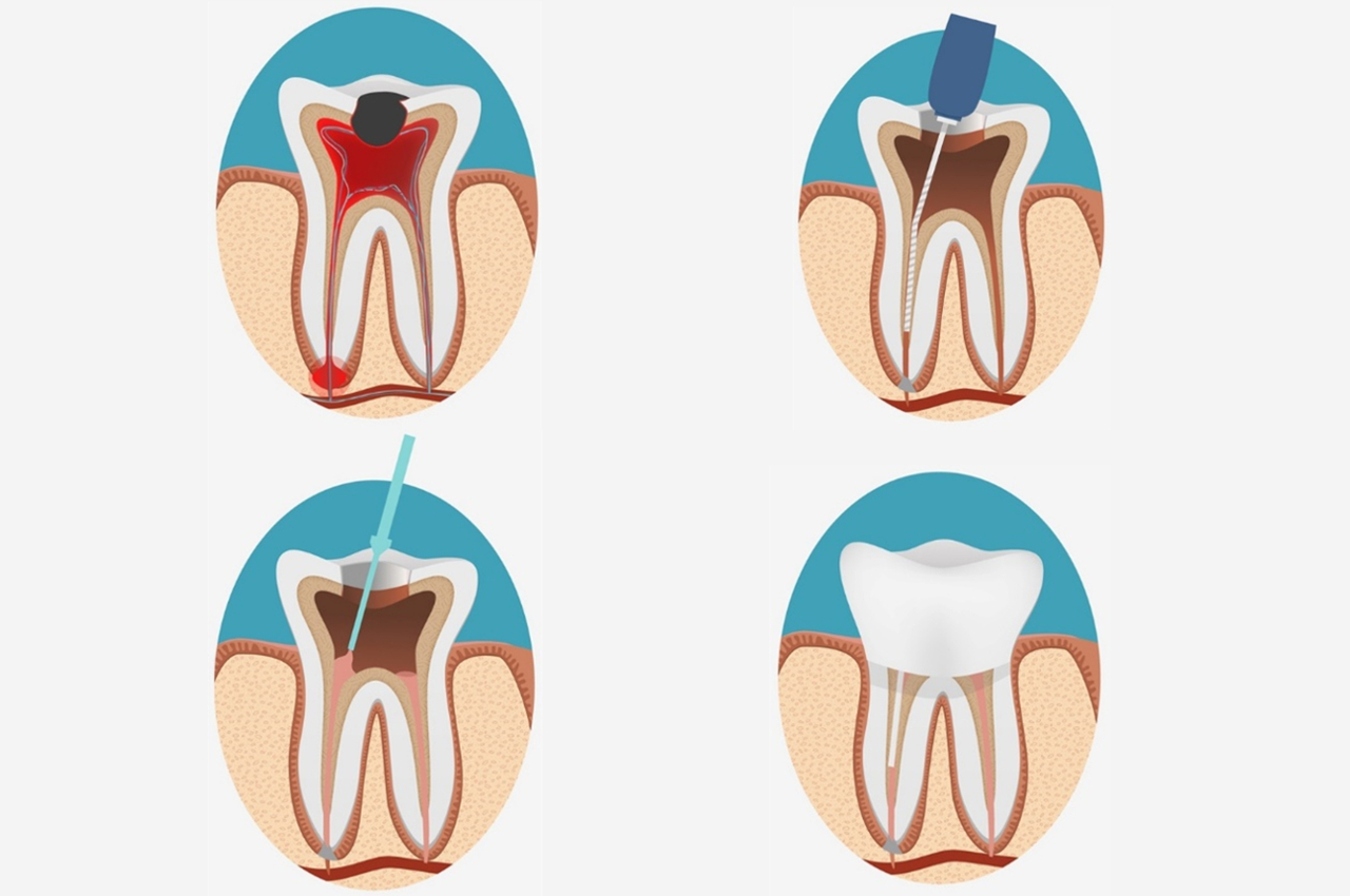 Endodoncia